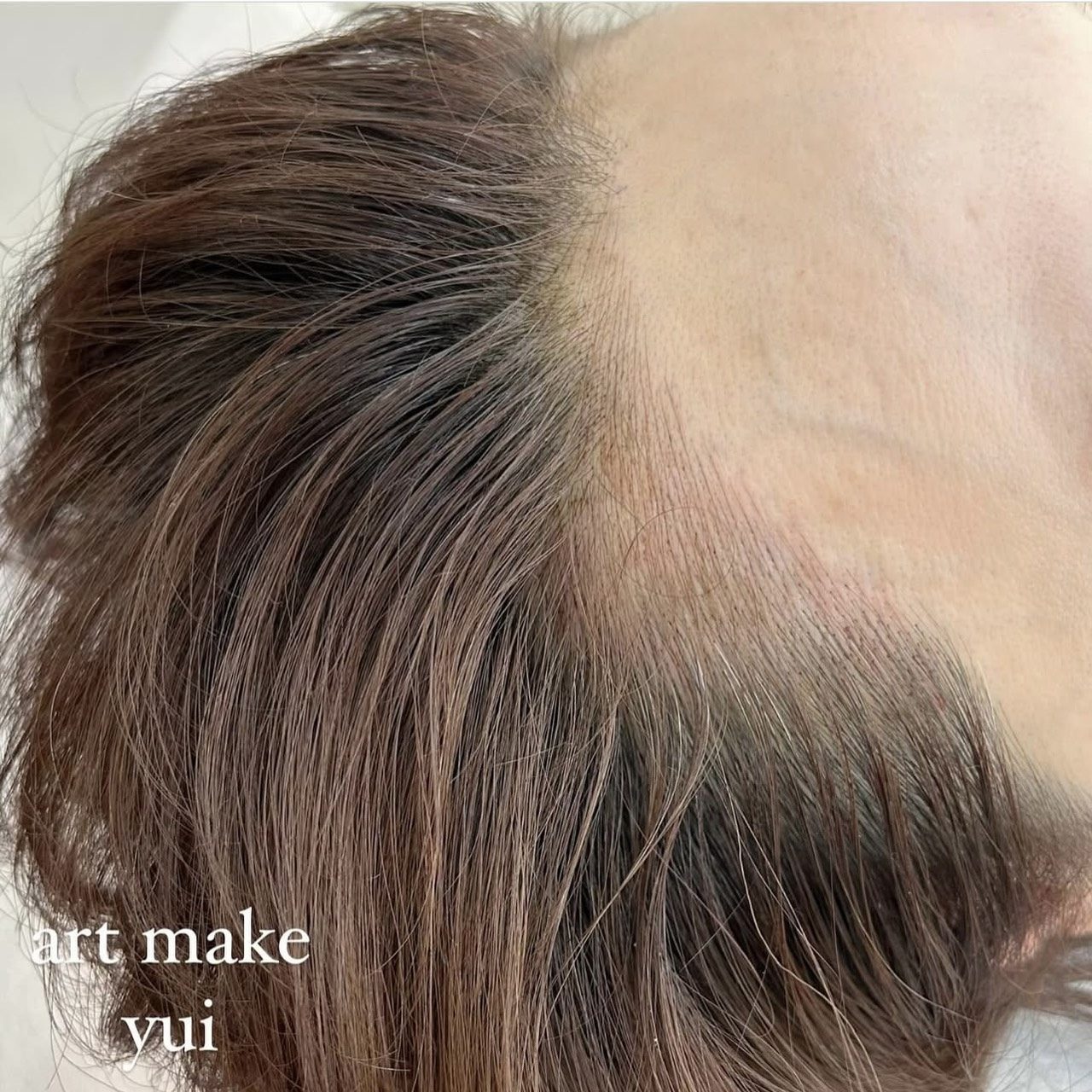 ヘアラインアートメイク症例写真(上白石)1