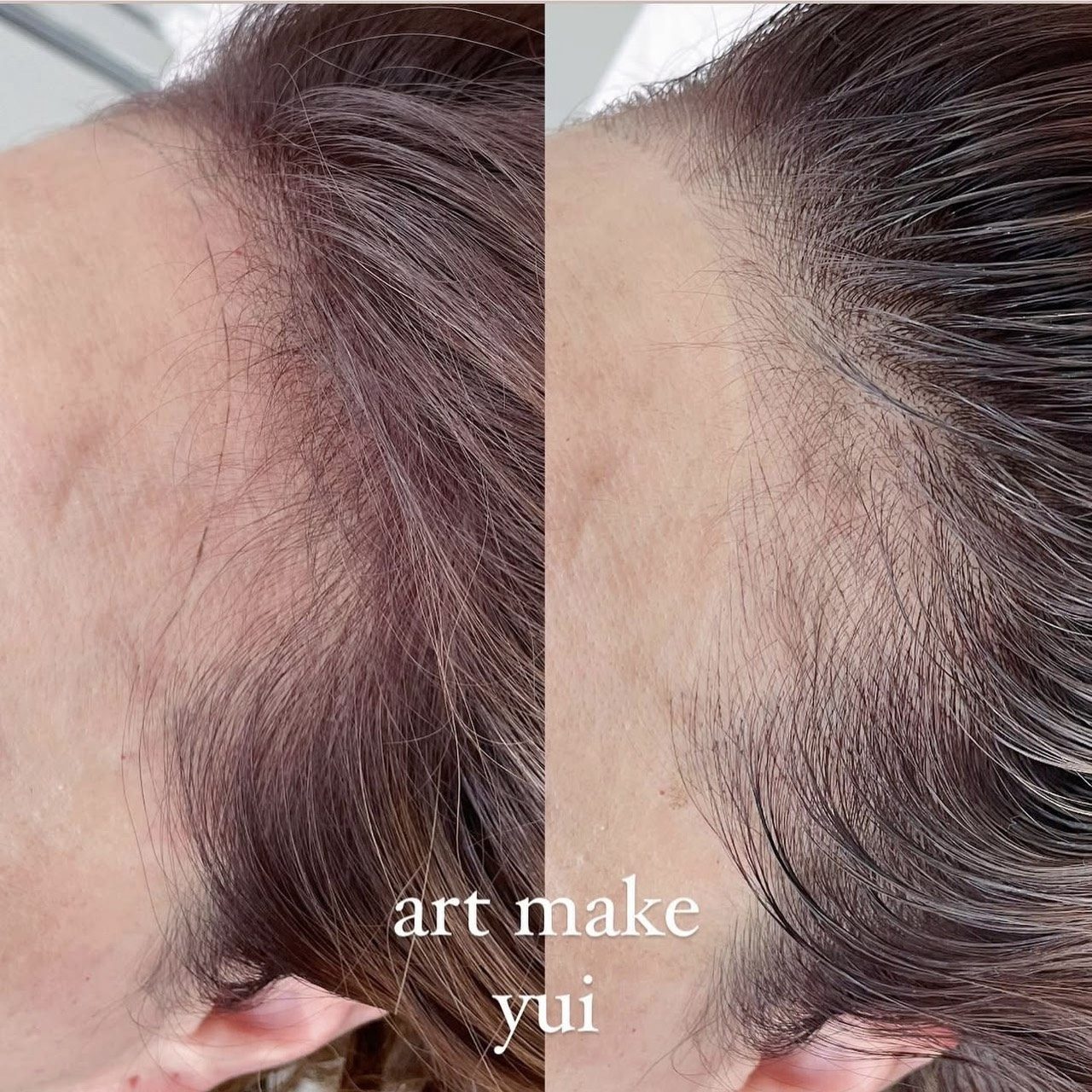 ヘアラインアートメイク症例写真(上白石)2