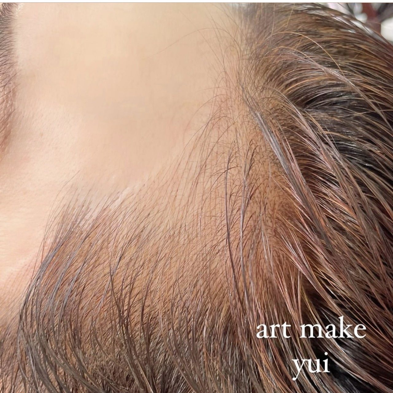 ヘアラインアートメイク症例写真(上白石)3