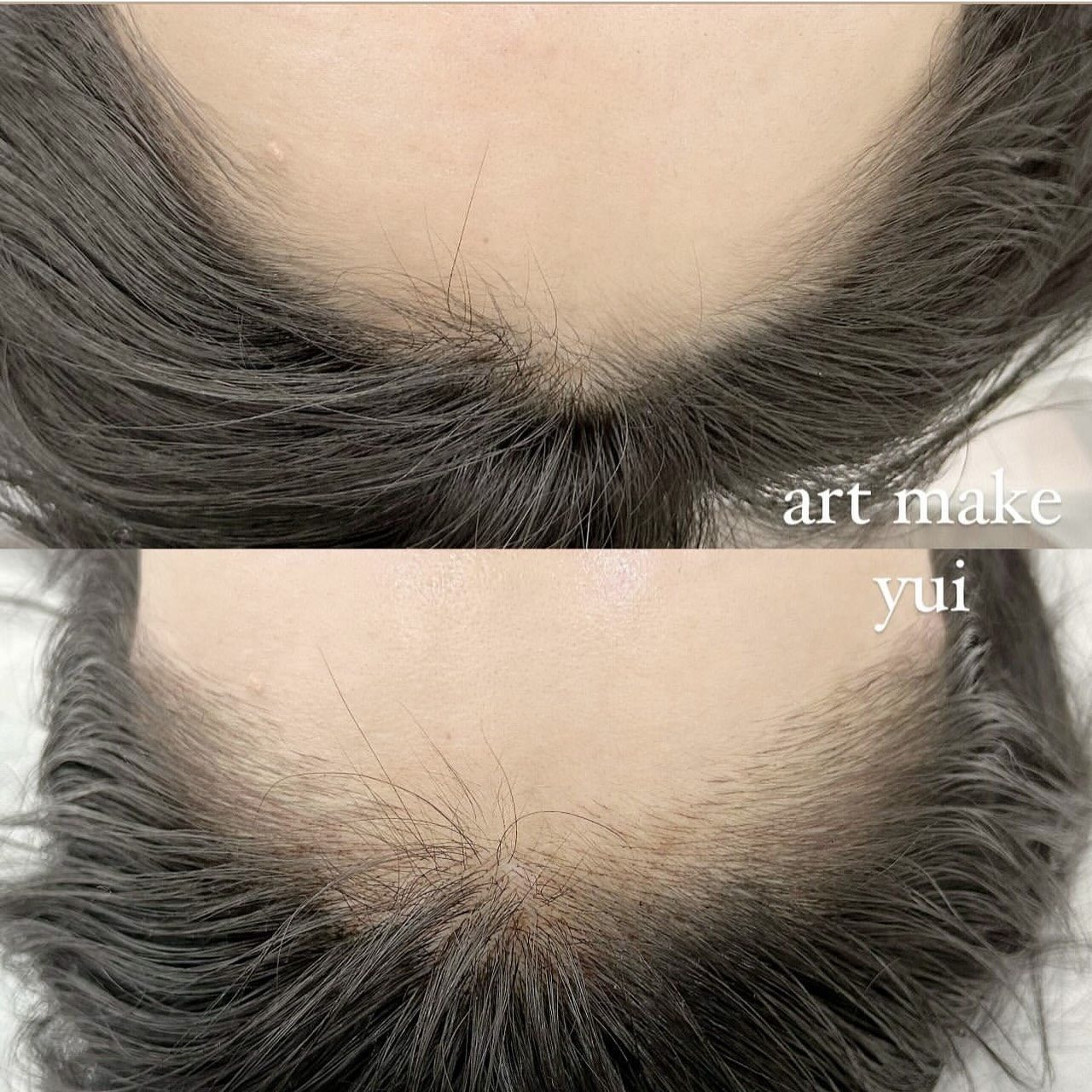 ヘアラインアートメイク症例写真(上白石)4