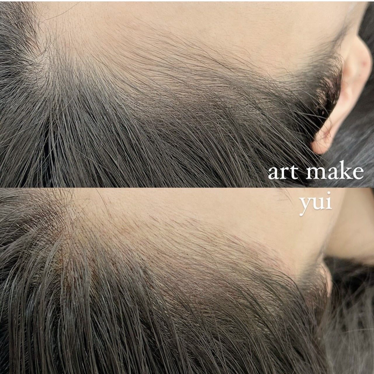 ヘアラインアートメイク症例写真(上白石)5