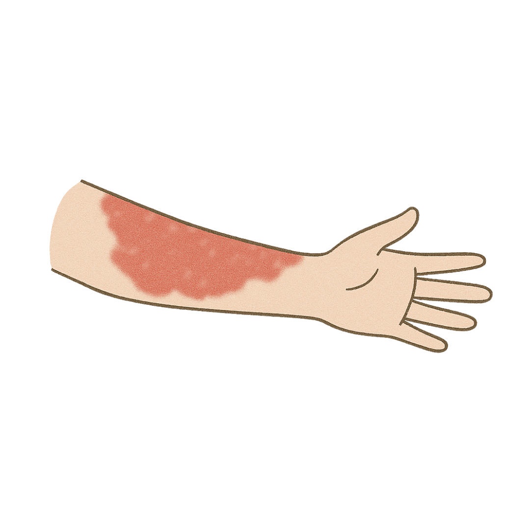 毛細血管腫の分布イメージ