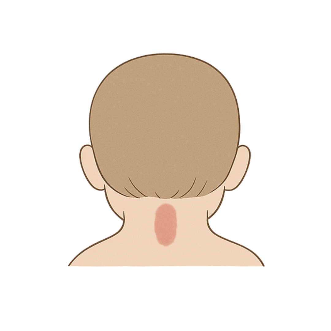 ?????????????Unna's nevus??????