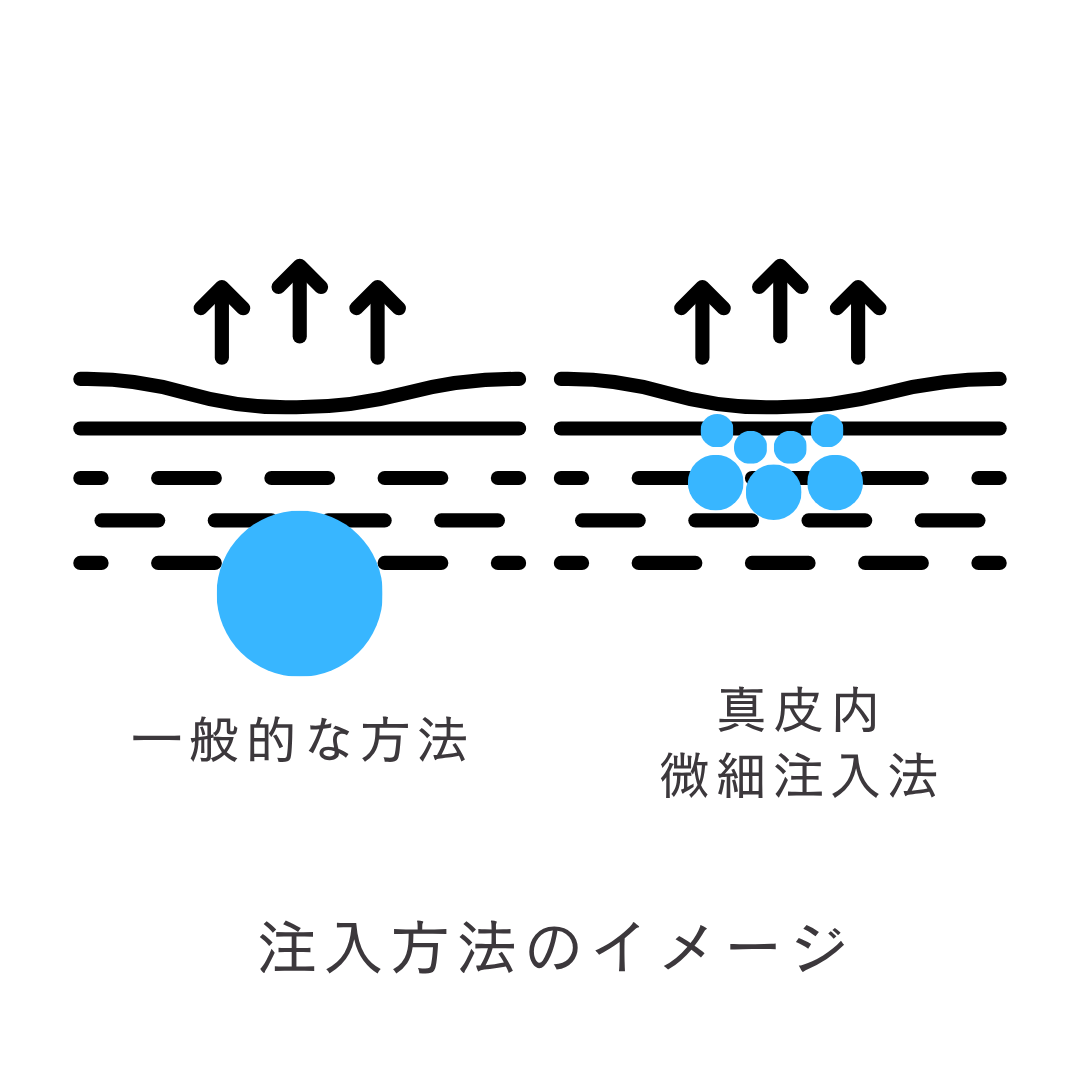 真皮内にヒアルロン酸を細かく注入する様子