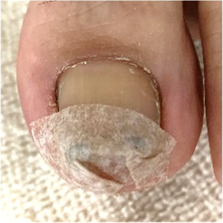 ネイルエイドを装着し、爪の先端をテープで保護した公式の写真